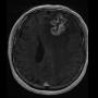 tumorfrontal.jpg