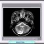 neurocitomaextraventricularrm.jpg